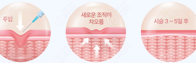 韩国自体真皮再生术价格