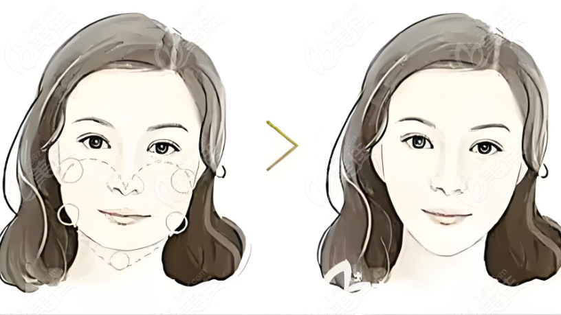 邱立东靠谱,磨骨下颌角不咋疼,手挺稳的www.236z.com