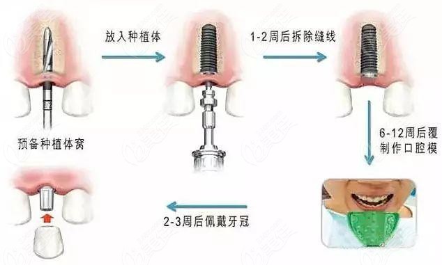 牙卫士口腔做种植牙手术的原理图