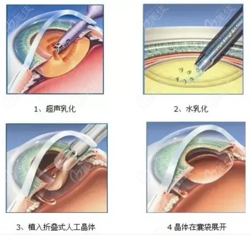 崔正元医生做白内障手术的原理图