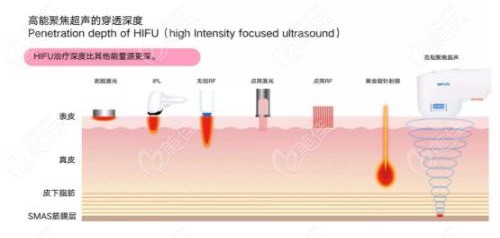 超声炮的作用功效 超声炮的作用功效