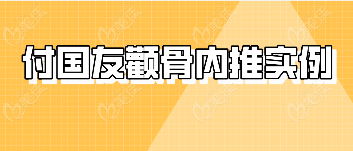 付国友颧骨内推实例