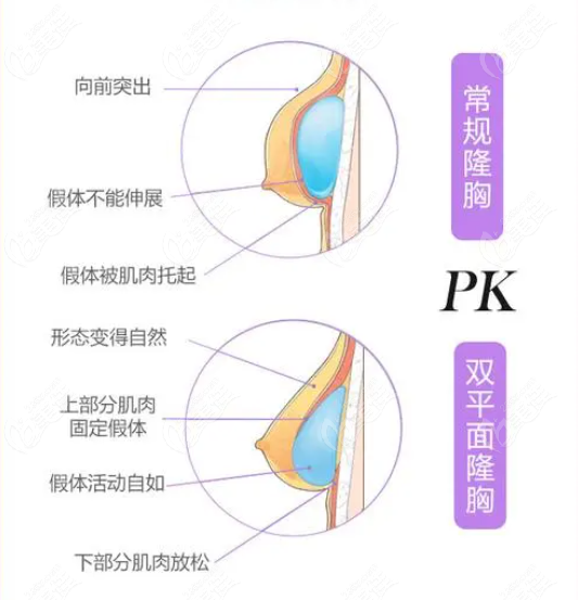 贵阳利美康假体隆胸优势
