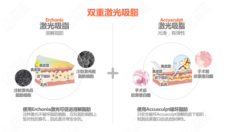 韩国体引脂整形医院的双重激光吸脂术