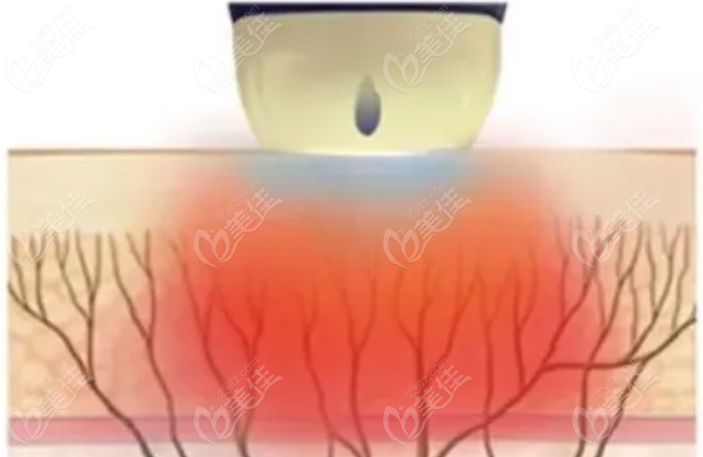 钛提升和热玛吉哪个好？痛感程度有差异