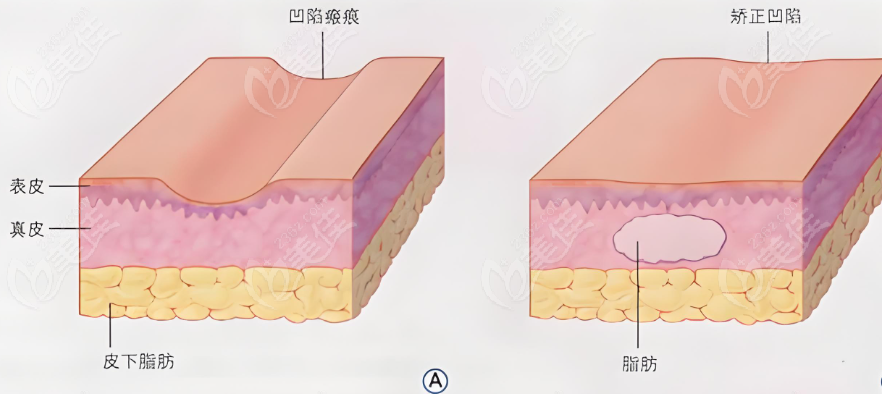 痘坑皮膚