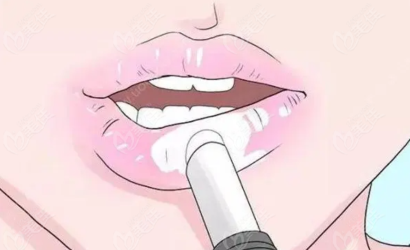  成都注射丰唇医院哪好?米兰柏羽/美莱/纯曦唇整形做的好附有医生推荐哦 美佳网