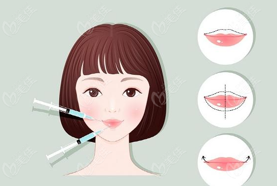  成都注射丰唇医院哪好?米兰柏羽/美莱/纯曦唇整形做的好附有医生推荐哦