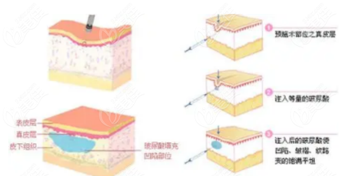 236z.com蒋铮铮医生注射手术