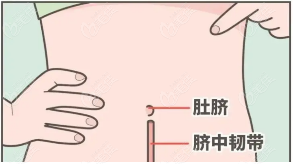 腹壁成型手术