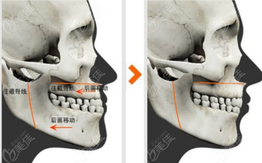 正颌手术示意图
