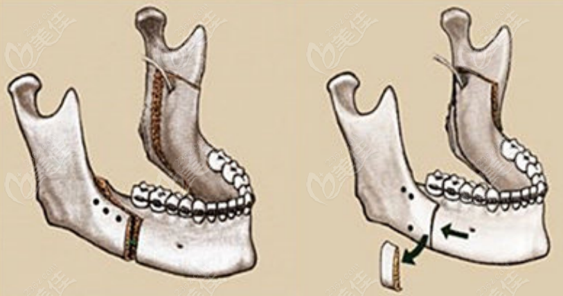 正颌手术示意图