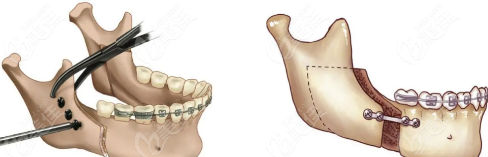 正颌手术示意图