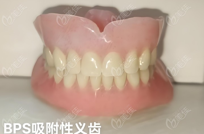 BPS全口吸附性义齿优势有哪些？
