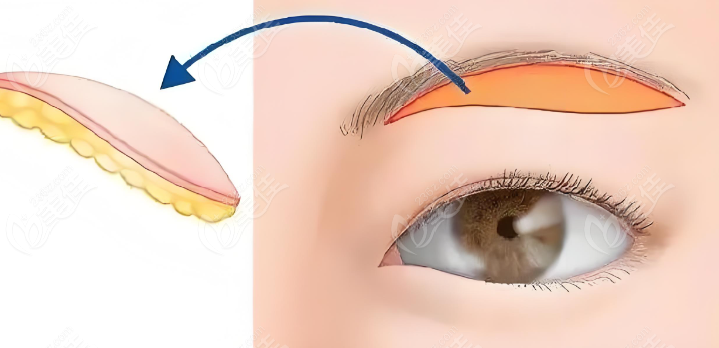 双眼皮眼修复手术