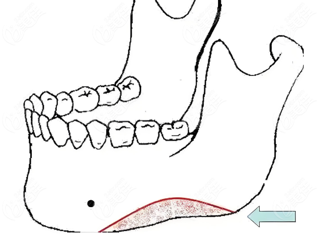 高俊明做磨骨手術(shù)失敗修復(fù)需要修復(fù)之處 高俊明做磨骨手術(shù)失敗修復(fù)需要修復(fù)之處