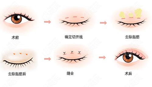 王方鹏医生做双眼皮手术的原理图