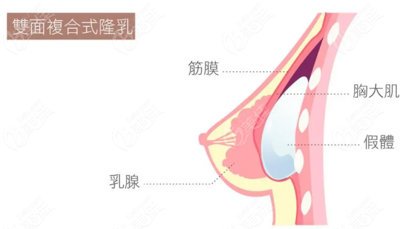 假体隆胸手术示意图