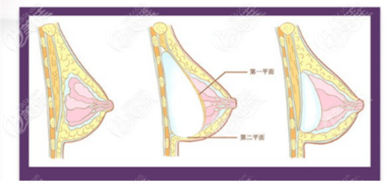 假体隆胸手术示意图