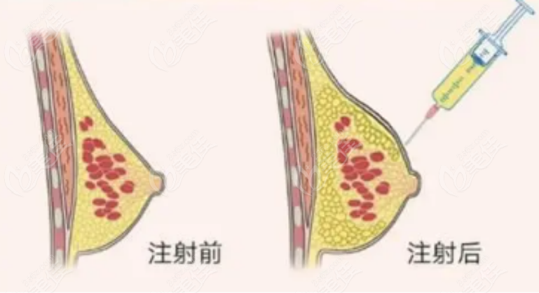 注射丰胸手术示意图