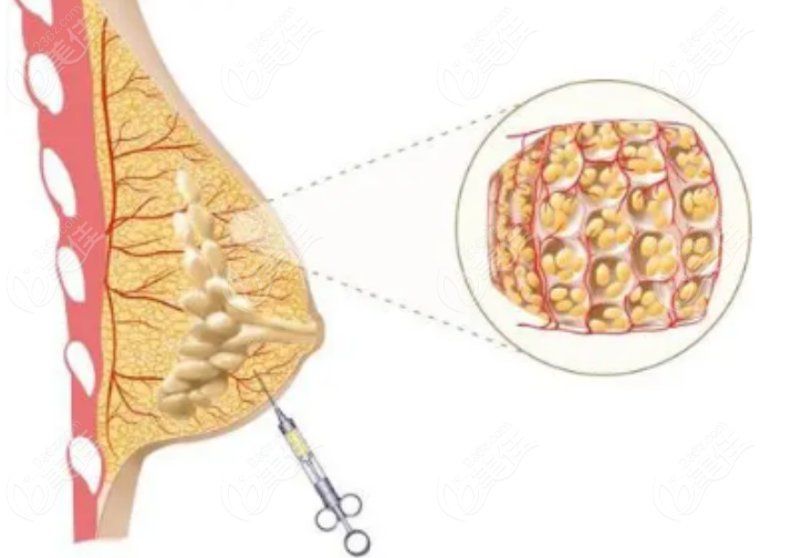 236z.com注射丰胸手术示意图