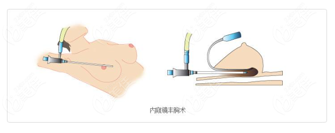 吴江山内窥镜隆胸创伤小