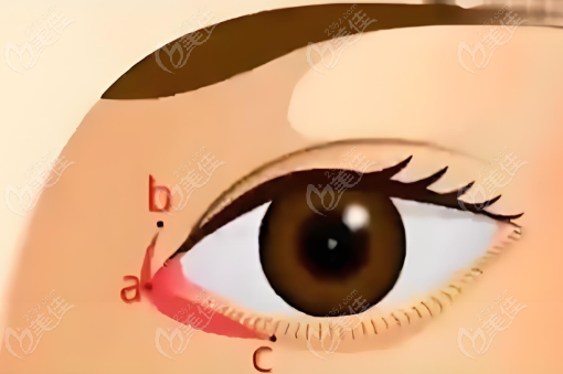 眼角手术