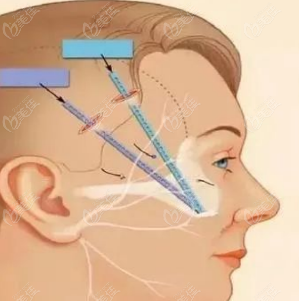 面部提升手术示意图