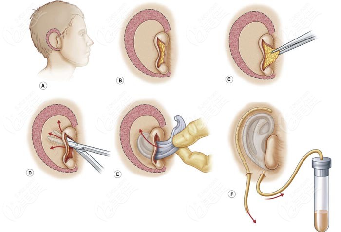 毋巨龙医生做耳再造手术的过程图www.236z.com