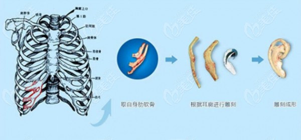 毋巨龙医生会采用自体软骨雕刻耳朵