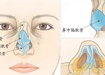 鼻子整形