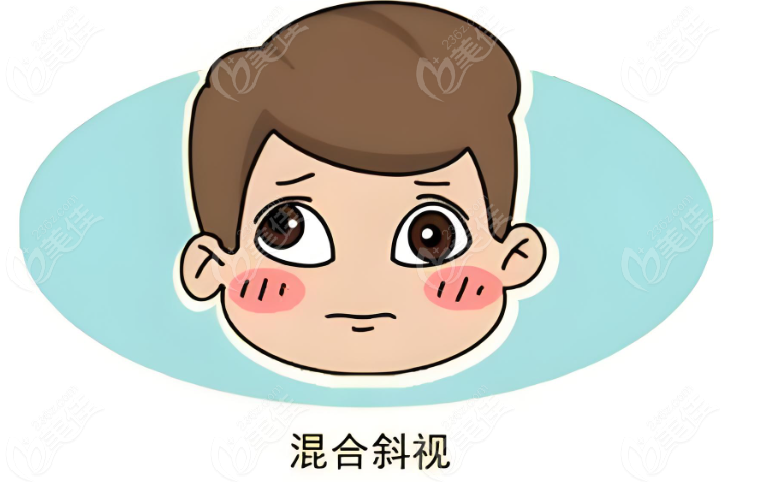 斜视