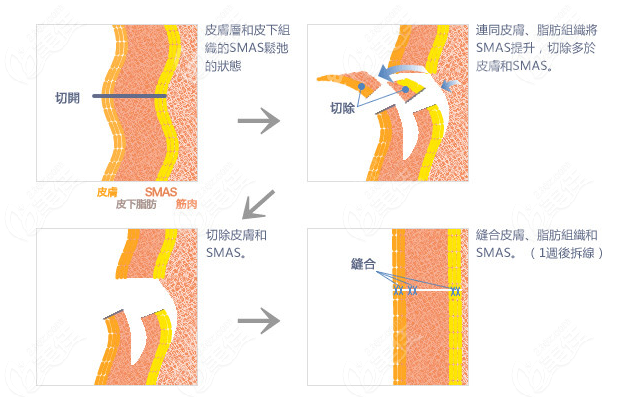 重庆做无痕筋膜提升的原理图www.236z.com