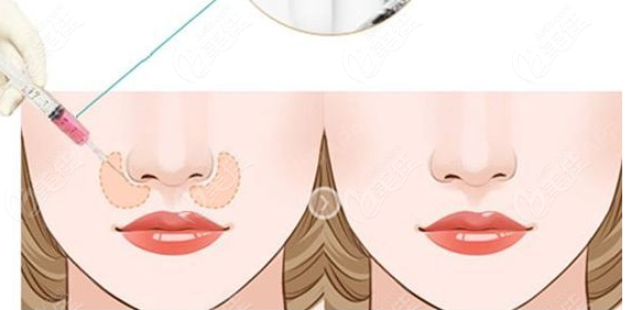鼻基底凹陷怎么做医美多少钱?玻尿酸/假体/自体脂肪填充价格不贵可冲m.23美@佳6z.co/m