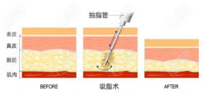 吸脂手术示意图