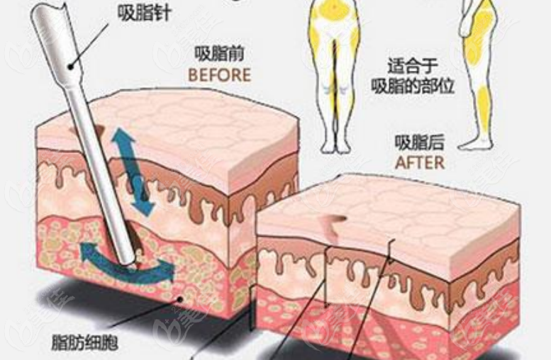 吸脂手术示意图