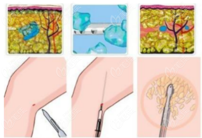 236z.com吸脂手术示意图