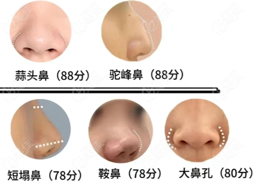 開封啟美整形隆鼻技術(shù)優(yōu)勢