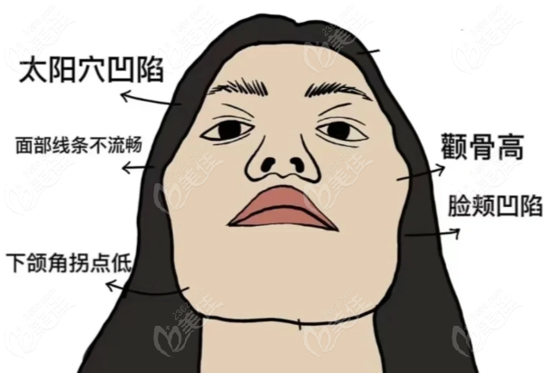 李继华颧骨手术技术好吗