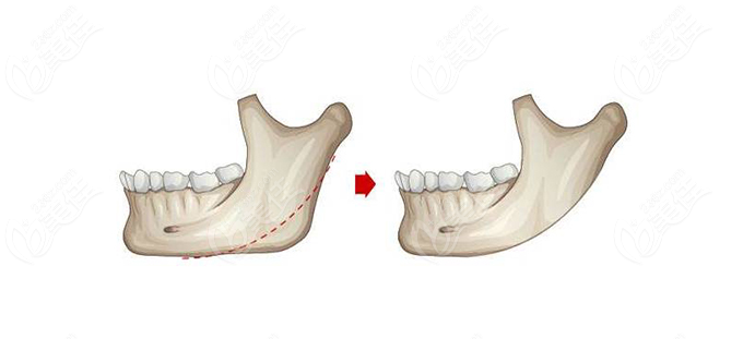 韓國(guó)做下頜角實(shí)例據(jù)說(shuō)你在找？美佳網(wǎng)