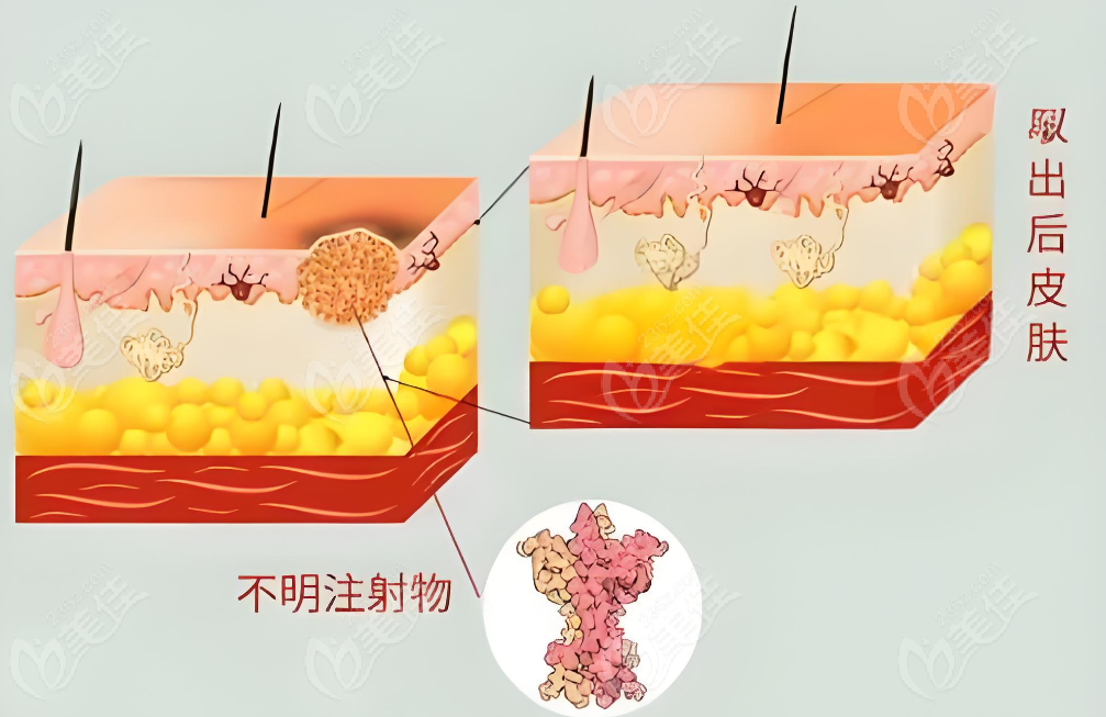 北京李方奇取生长因子干净
