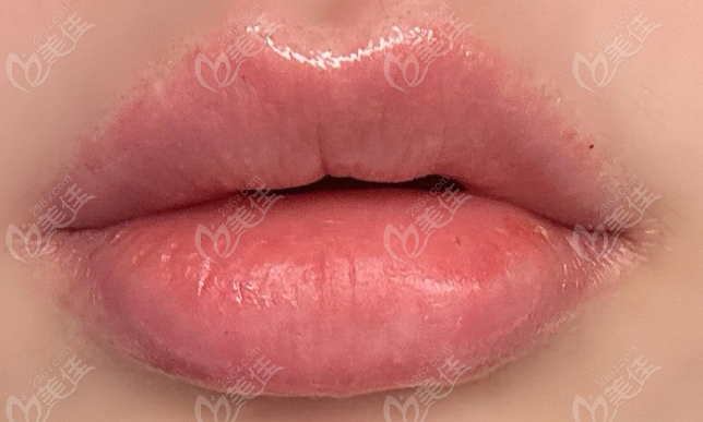 选择韩国orbit皮肤科嘟嘴+打卧蚕的亲身体验 选择韩国orbit皮肤科嘟嘴+打卧蚕的亲身体验