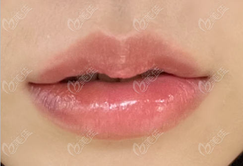 韓國reyou皮膚科do嘴