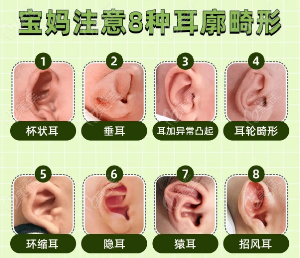 新生儿耳朵轮廓畸形自己能长好吗