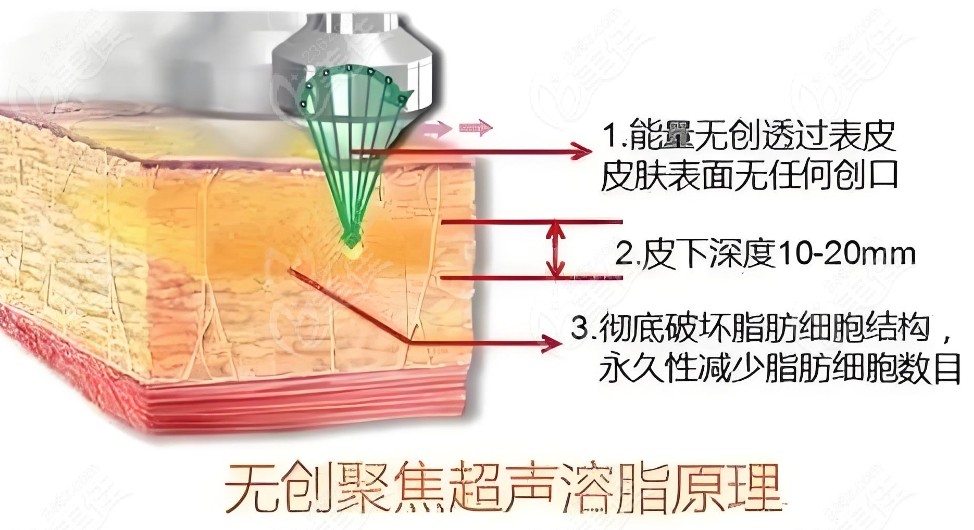 抽脂手术