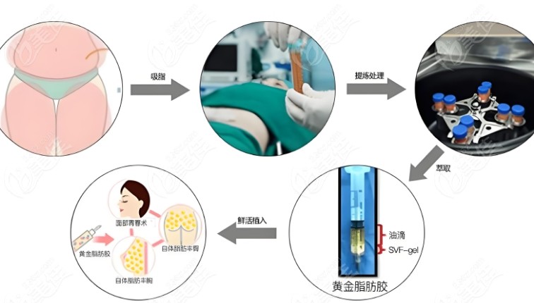 任学会吸脂真人实例