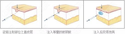 军科整形做玻尿酸填充的医生经验都ok