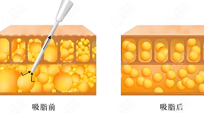 北京禾美嘉任学会抽脂价格得多少钱？