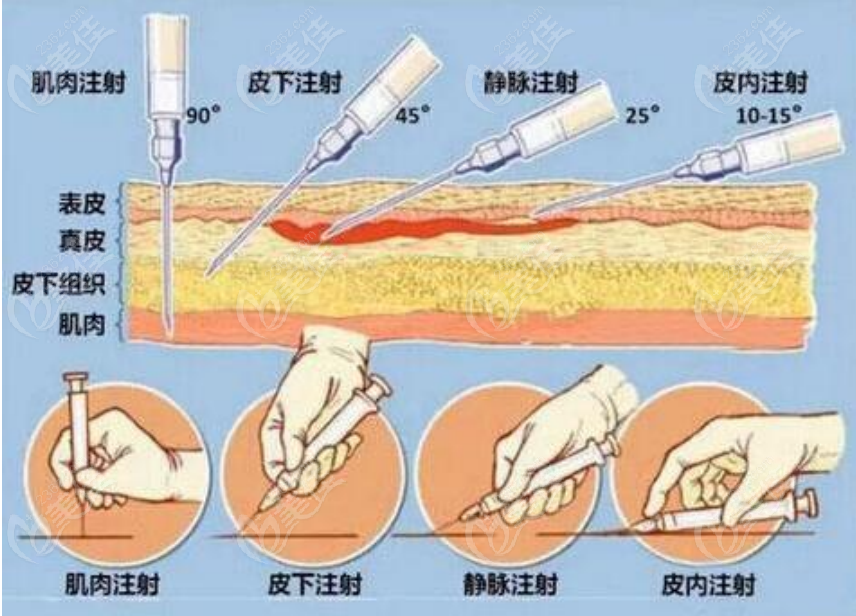 韩国DoctorPetit皮肤科玻尿酸注射