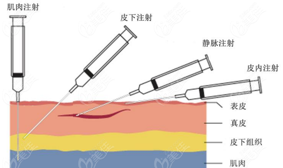 韩国DoctorPetit皮肤科玻尿酸注射